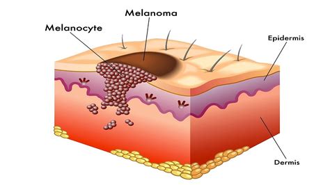 melanoma cancer definition